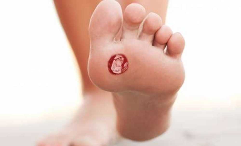 Şeker Hastalığına Bağlı Ayak Yaraları