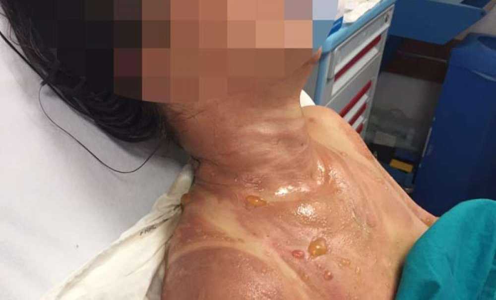 Kaynananın Gelinini Kızgın Yağ Ile Yaktığı İddiası