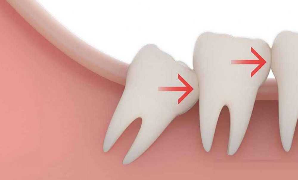 Gömülü Dişler Neden Alınmalıdır?