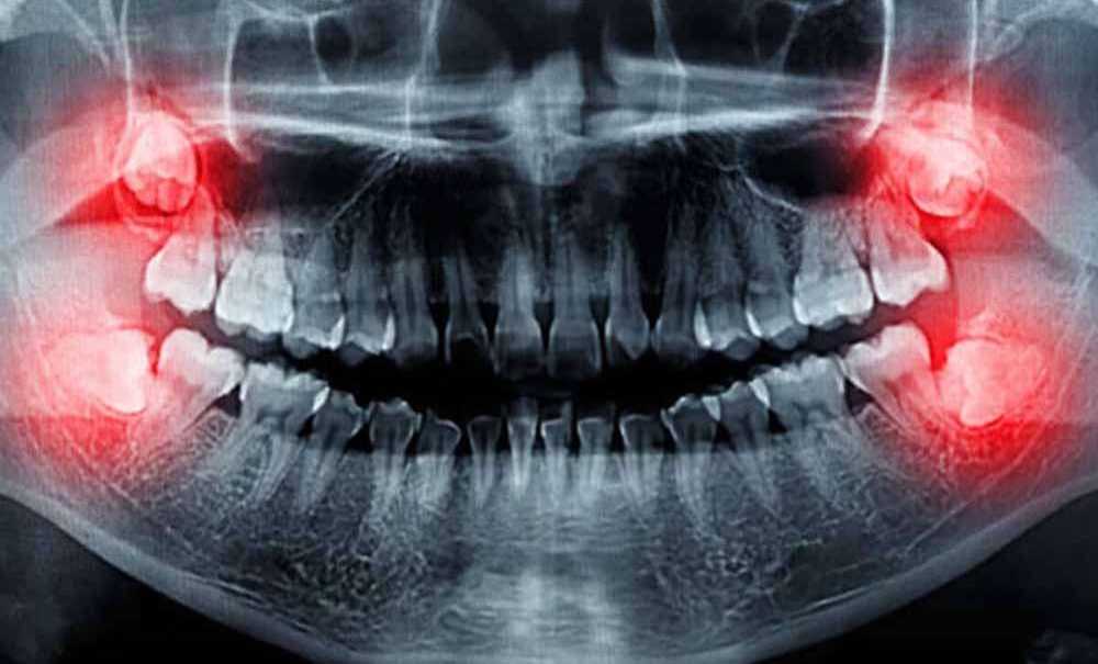 Gömülü Dişler Neden Alınmalıdır?