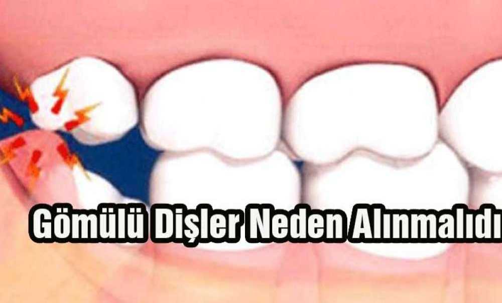 Gömülü Dişler Neden Alınmalıdır?