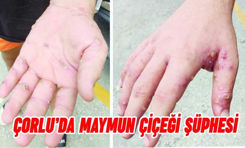 Çorlu'da Maymun Çiçeği Şüphesi!