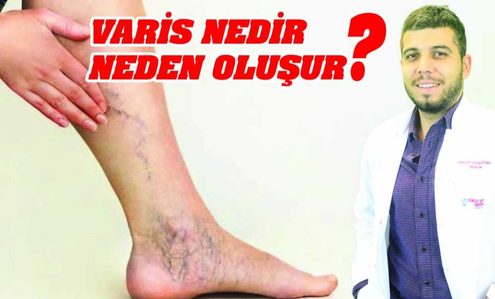 Vari̇s Nedi̇r ? Neden Oluşur?